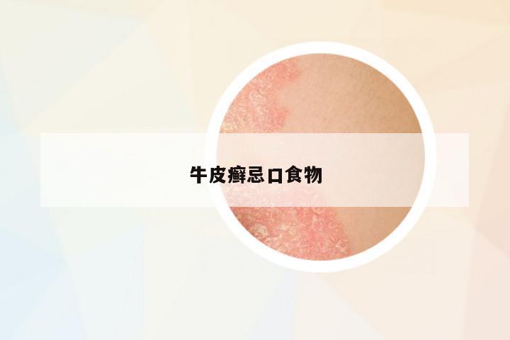 牛皮癬忌口食物