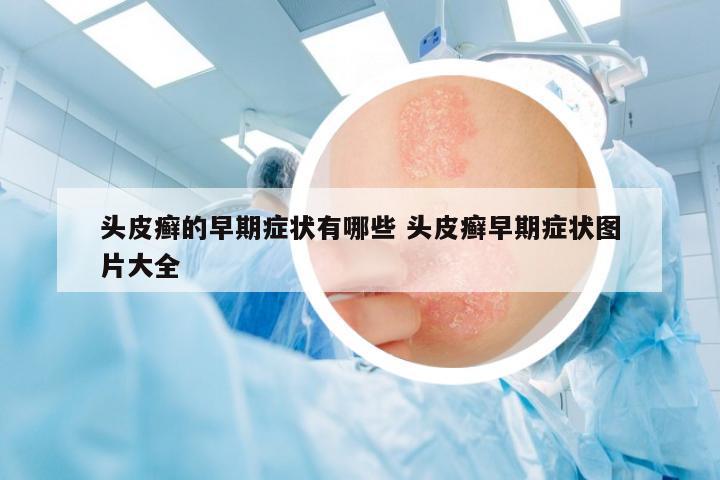 頭皮癬的早期癥狀有哪些 頭皮癬早期癥狀圖片大全