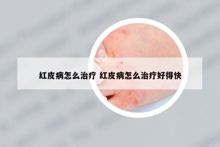 紅皮病怎么治療 紅皮病怎么治療好得快
