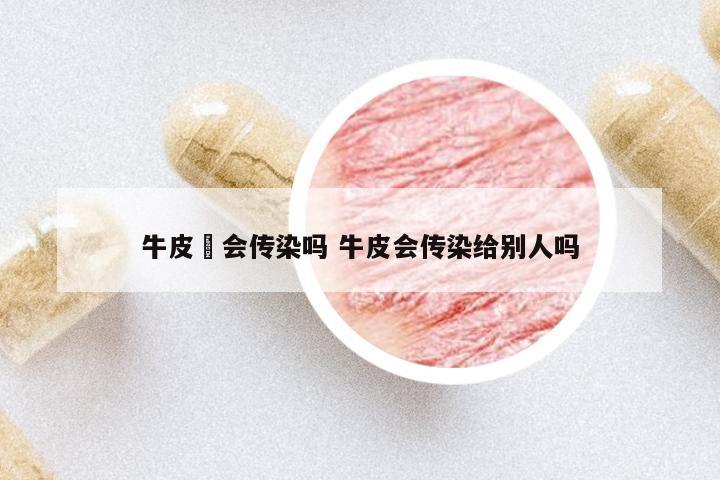 牛皮廯會(huì)傳染嗎 牛皮會(huì)傳染給別人嗎
