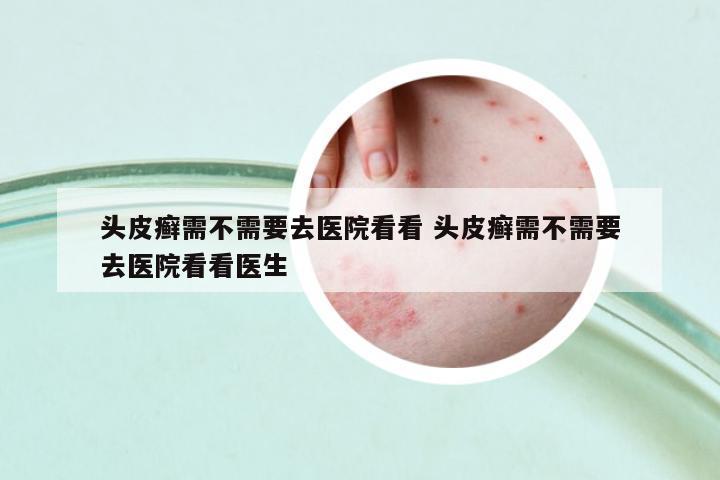 頭皮癬需不需要去醫(yī)院看看 頭皮癬需不需要去醫(yī)院看看醫(yī)生