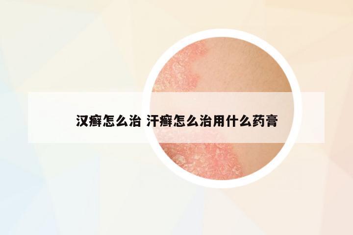 漢癬怎么治 汗癬怎么治用什么藥膏