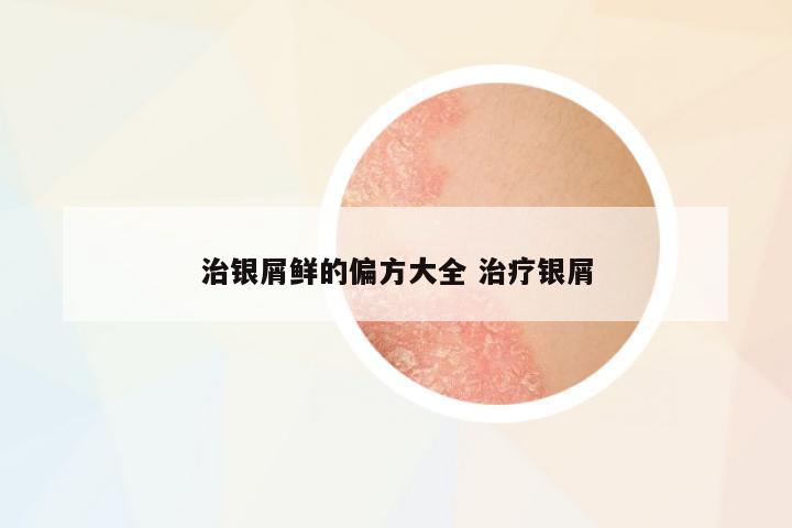 治銀屑鮮的偏方大全 治療銀屑