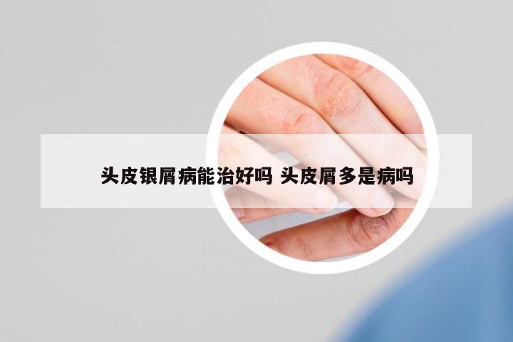 頭皮銀屑病能治好嗎 頭皮屑多是病嗎