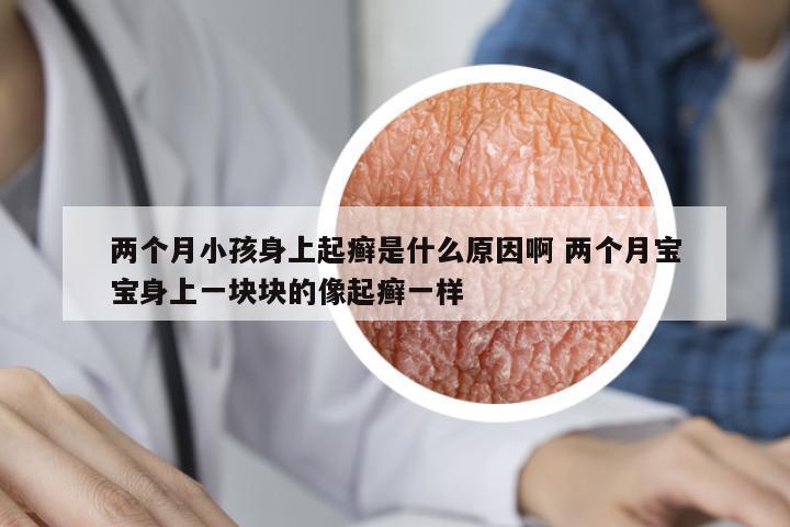 兩個(gè)月小孩身上起癬是什么原因啊 兩個(gè)月寶寶身上一塊塊的像起癬一樣