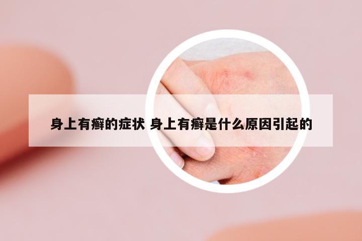 身上有癬的癥狀 身上有癬是什么原因引起的