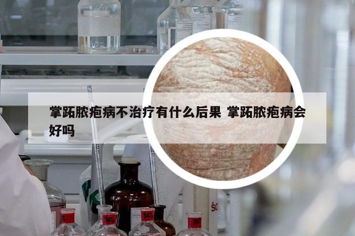 掌跖膿皰病不治療有什么后果 掌跖膿皰病會(huì)好嗎