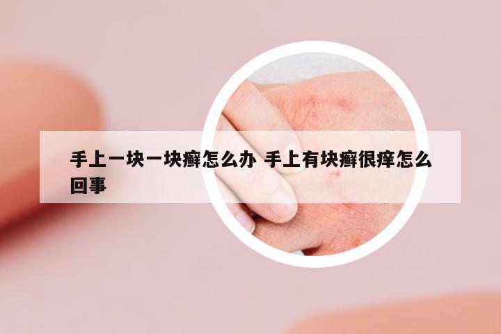 手上一塊一塊癬怎么辦 手上有塊癬很癢怎么回事