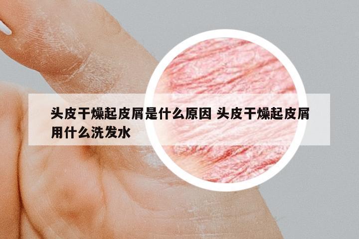 頭皮干燥起皮屑是什么原因 頭皮干燥起皮屑用什么洗發(fā)水