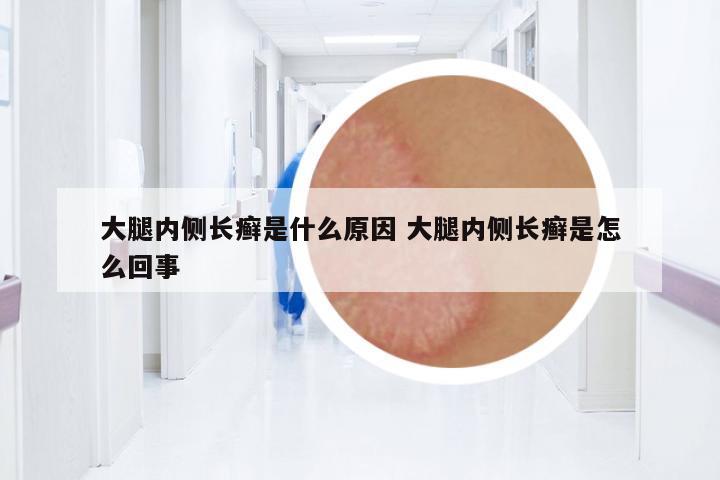 大腿內(nèi)側(cè)長癬是什么原因 大腿內(nèi)側(cè)長癬是怎么回事