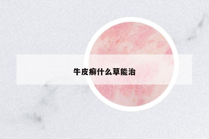 牛皮癬什么草能治