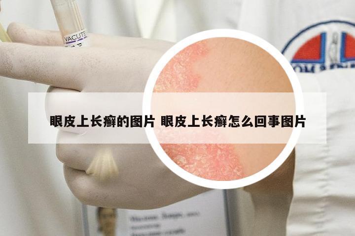 眼皮上長(zhǎng)癬的圖片 眼皮上長(zhǎng)癬怎么回事圖片