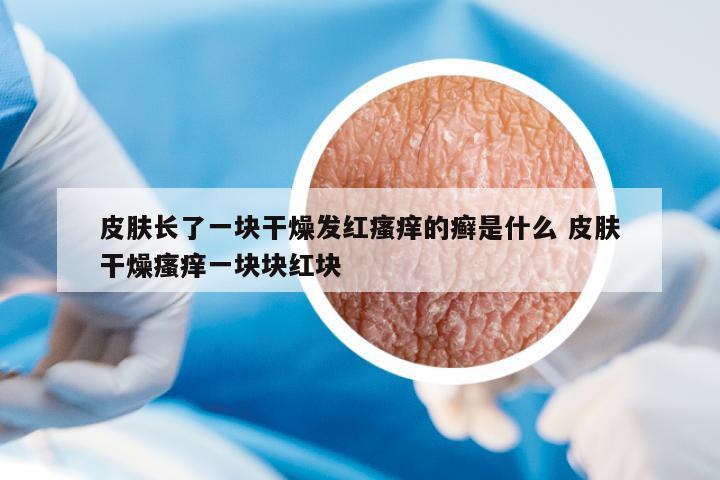 皮膚長了一塊干燥發(fā)紅瘙癢的癬是什么 皮膚干燥瘙癢一塊塊紅塊