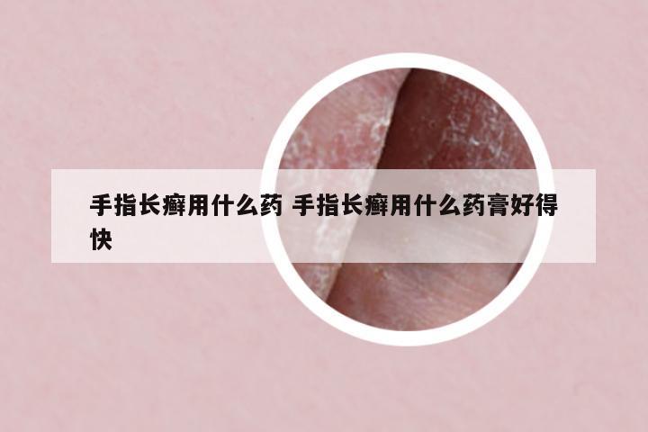 手指長癬用什么藥 手指長癬用什么藥膏好得快
