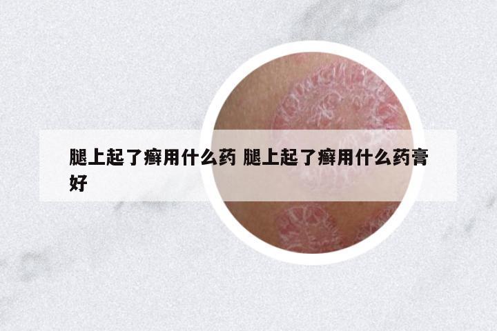 腿上起了癬用什么藥 腿上起了癬用什么藥膏好