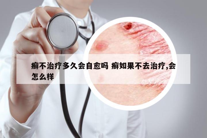 癬不治療多久會自愈嗎 癬如果不去治療,會怎么樣
