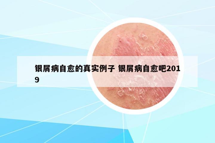 銀屑病自愈的真實例子 銀屑病自愈吧2019