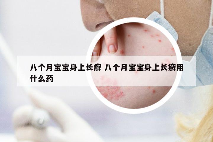 八個(gè)月寶寶身上長(zhǎng)癬 八個(gè)月寶寶身上長(zhǎng)癬用什么藥