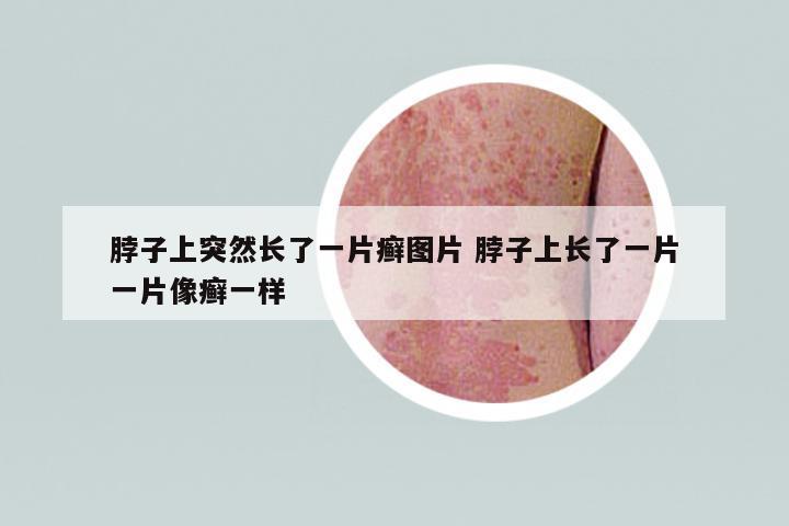 脖子上突然長了一片癬圖片 脖子上長了一片一片像癬一樣