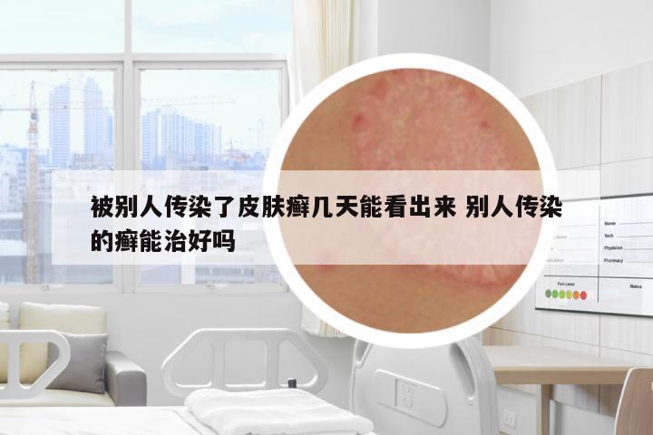 被別人傳染了皮膚癬幾天能看出來 別人傳染的癬能治好嗎