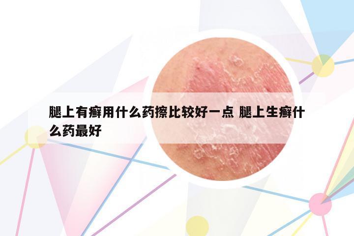 腿上有癬用什么藥擦比較好一點(diǎn) 腿上生癬什么藥最好