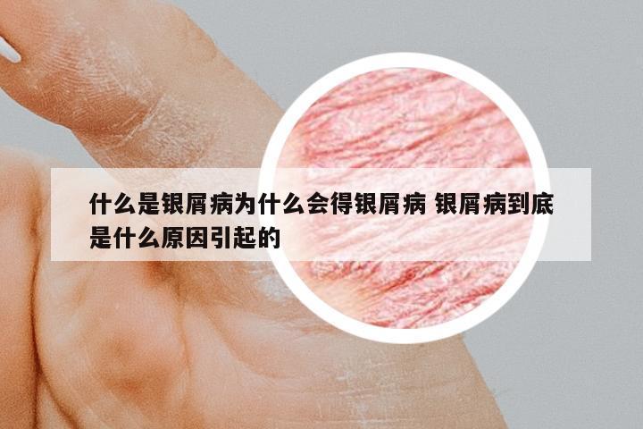 什么是銀屑病為什么會(huì)得銀屑病 銀屑病到底是什么原因引起的