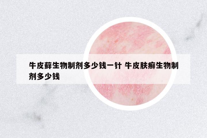 牛皮蘚生物制劑多少錢一針 牛皮膚癬生物制劑多少錢