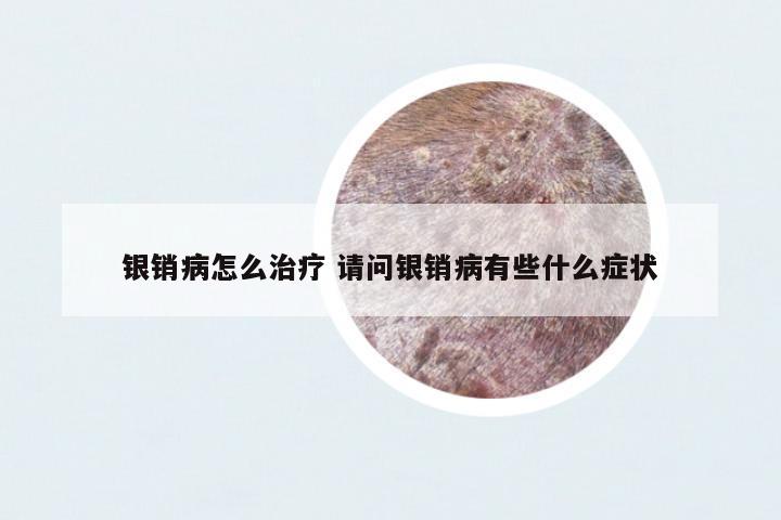銀銷病怎么治療 請(qǐng)問銀銷病有些什么癥狀
