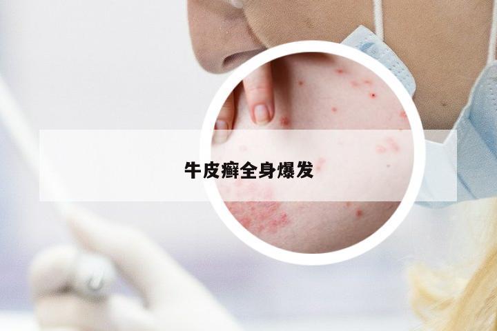 牛皮癬全身爆發(fā)