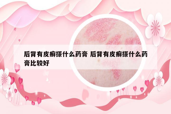 后背有皮癬搽什么藥膏 后背有皮癬搽什么藥膏比較好