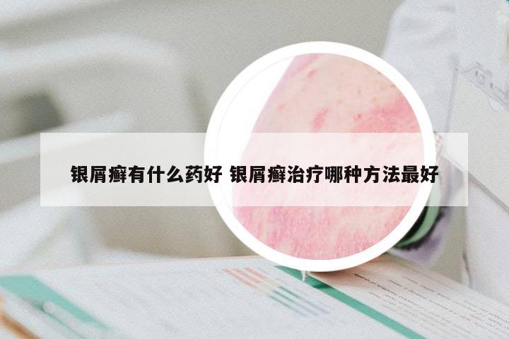 銀屑癬有什么藥好 銀屑癬治療哪種方法最好