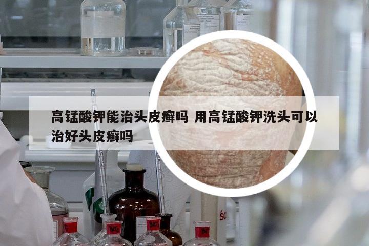 高錳酸鉀能治頭皮癬嗎 用高錳酸鉀洗頭可以治好頭皮癬嗎