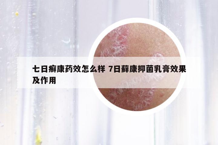 七日癬康藥效怎么樣 7日蘚康抑菌乳膏效果及作用