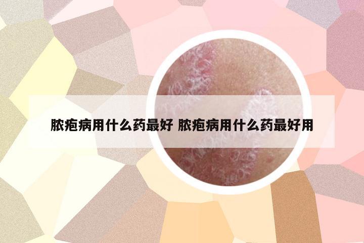 膿皰病用什么藥最好 膿皰病用什么藥最好用