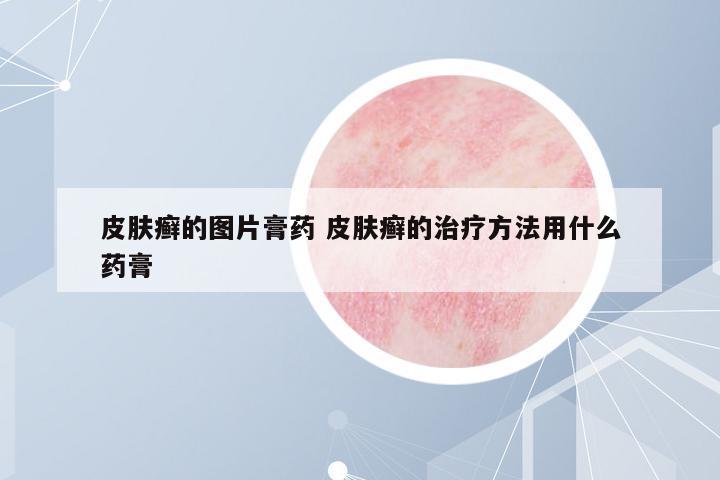 皮膚癬的圖片膏藥 皮膚癬的治療方法用什么藥膏