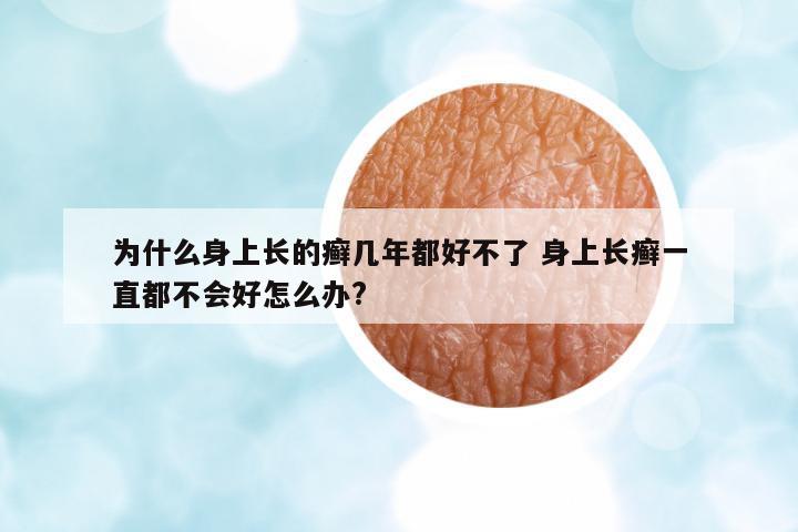 為什么身上長的癬幾年都好不了 身上長癬一直都不會好怎么辦?
