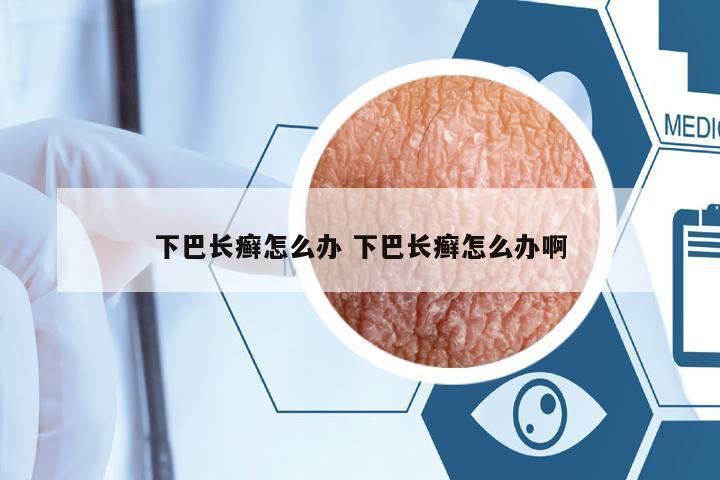 下巴長癬怎么辦 下巴長癬怎么辦啊