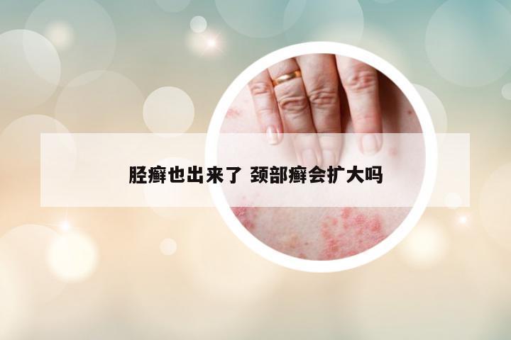 脛癬也出來了 頸部癬會(huì)擴(kuò)大嗎