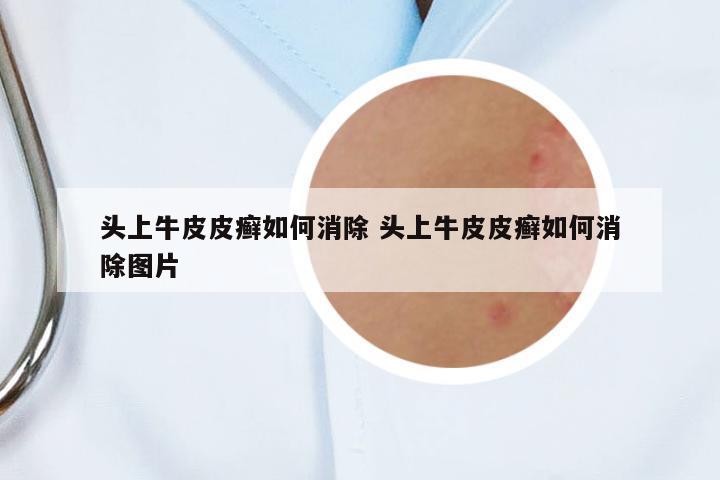 頭上牛皮皮癬如何消除 頭上牛皮皮癬如何消除圖片
