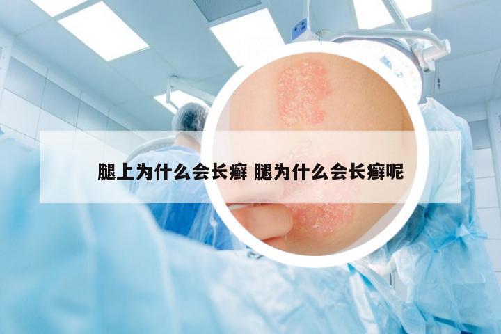 腿上為什么會(huì)長癬 腿為什么會(huì)長癬呢
