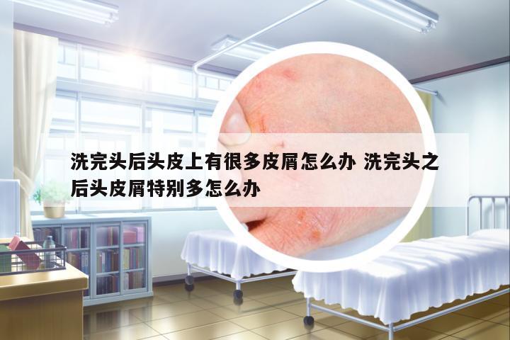洗完頭后頭皮上有很多皮屑怎么辦 洗完頭之后頭皮屑特別多怎么辦