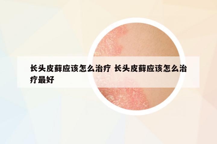 長頭皮蘚應(yīng)該怎么治療 長頭皮蘚應(yīng)該怎么治療最好