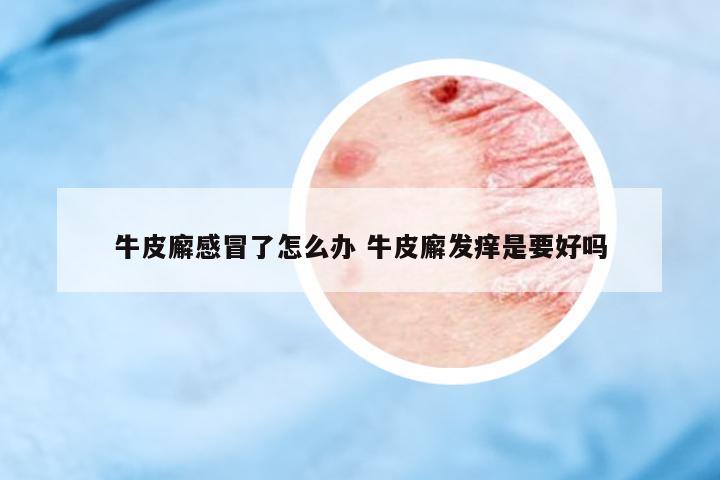 牛皮廨感冒了怎么辦 牛皮廨發(fā)癢是要好嗎