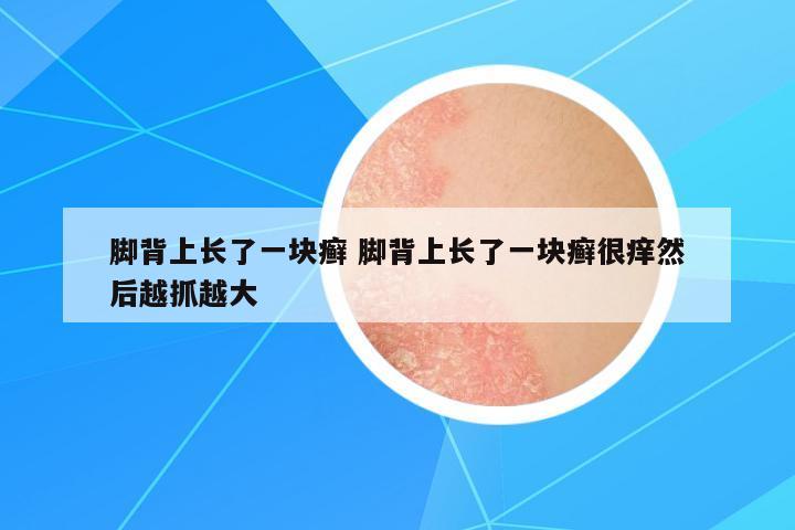腳背上長了一塊癬 腳背上長了一塊癬很癢然后越抓越大