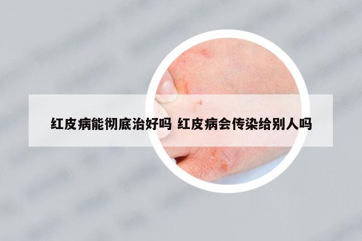 紅皮病能徹底治好嗎 紅皮病會傳染給別人嗎