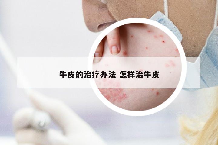 牛皮的治療辦法 怎樣治牛皮