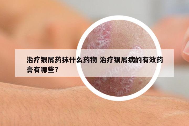 治療銀屑藥抹什么藥物 治療銀屑病的有效藥膏有哪些?