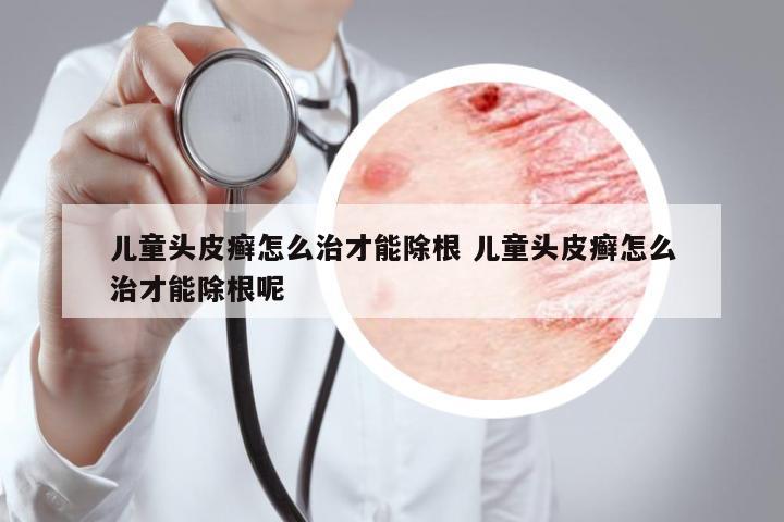 兒童頭皮癬怎么治才能除根 兒童頭皮癬怎么治才能除根呢