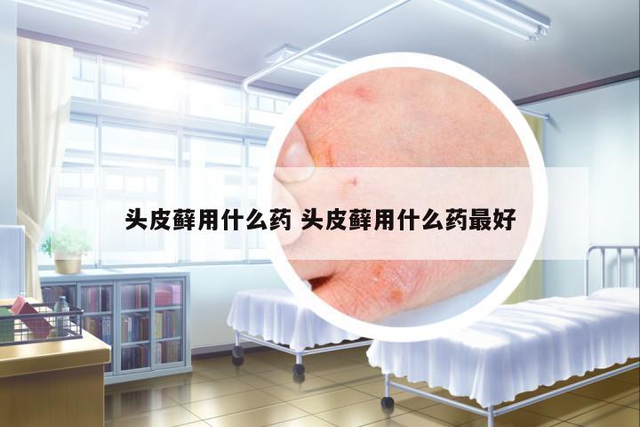 頭皮蘚用什么藥 頭皮蘚用什么藥最好
