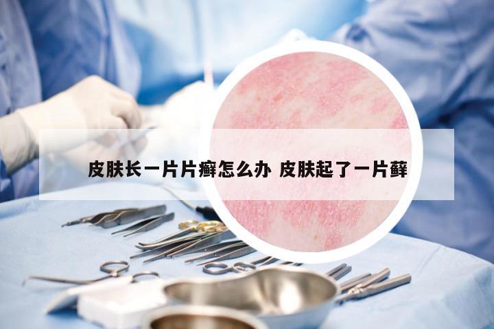 皮膚長一片片癬怎么辦 皮膚起了一片蘚